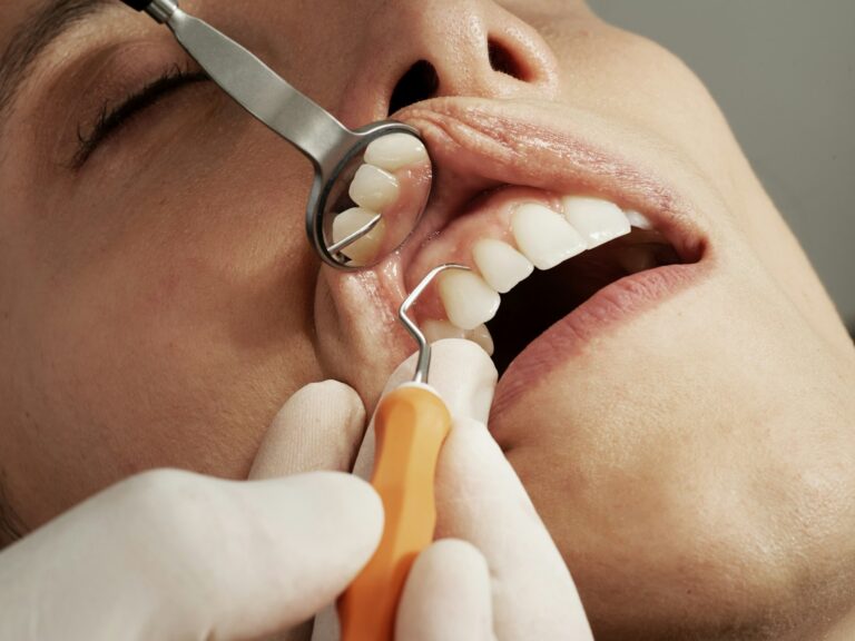 Can You Get Dry Sockets With Stitches