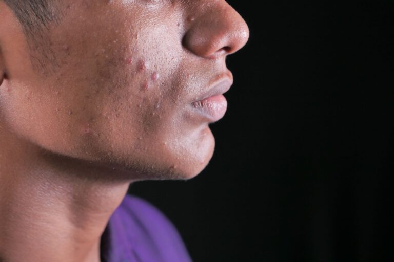 Can Ashwagandha Cause Acne