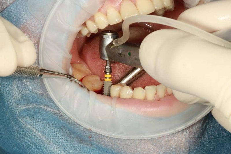 Top Questions To Ask Before Getting Dental Implants